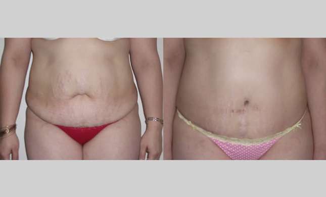 Tummy Tuck: Image #261