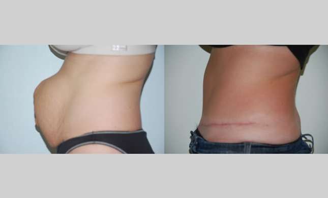 Tummy Tuck: Image #262