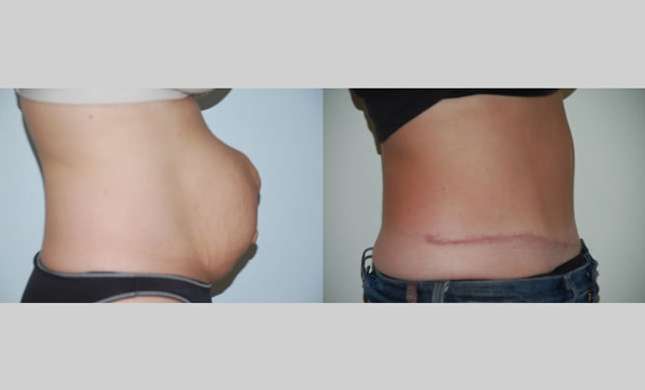 Tummy Tuck: Image #263