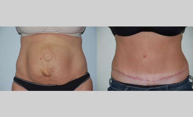 Tummy Tuck: Image #264