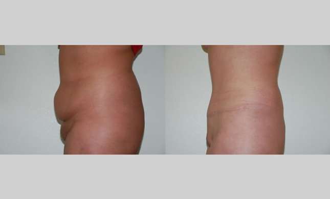 Tummy Tuck: Image #265