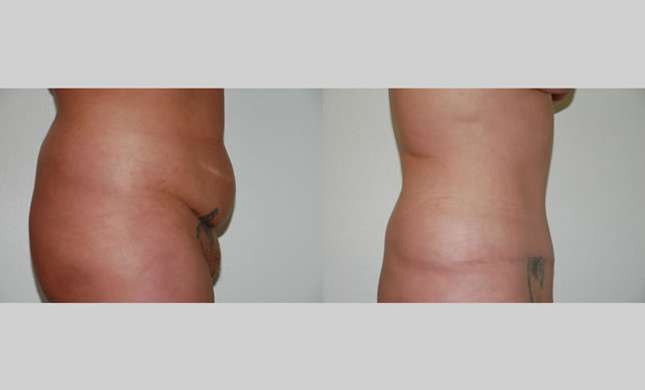 Tummy Tuck: Image #266