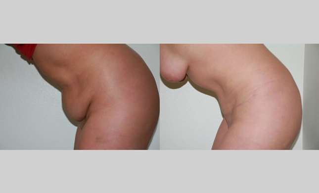 Tummy Tuck: Image #267