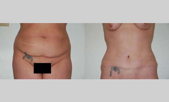 Tummy Tuck: Image #268