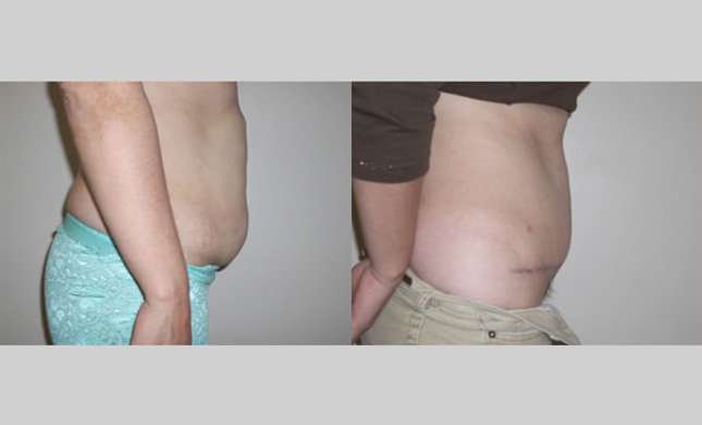 Tummy Tuck: Image #269