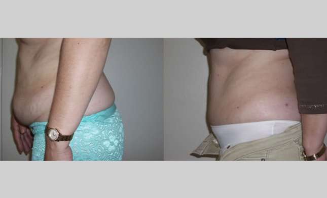 Tummy Tuck: Image #270