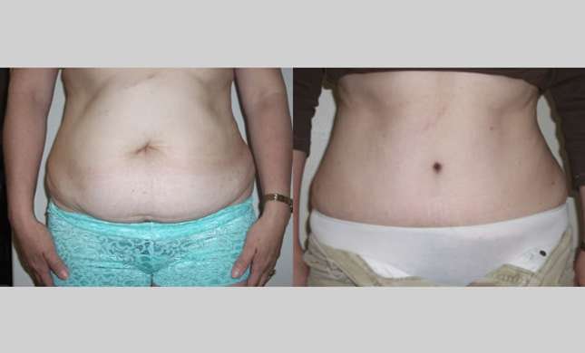 Tummy Tuck: Image #271