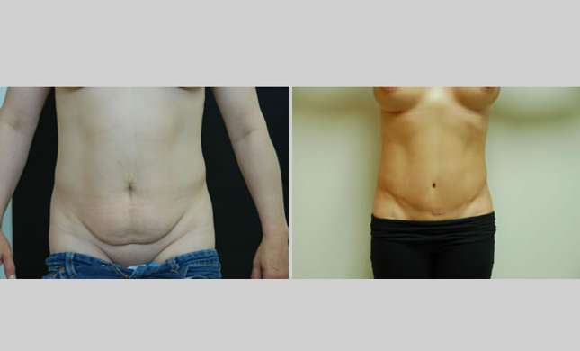 Tummy Tuck: Image #272