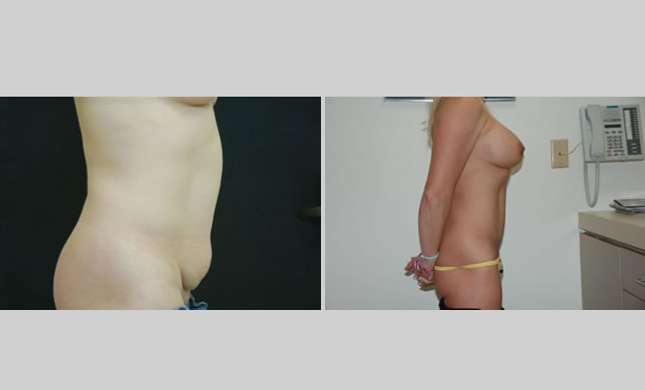 Tummy Tuck: Image #273
