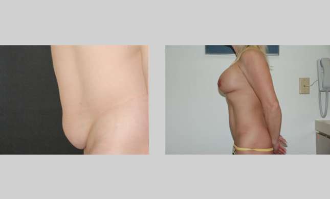Tummy Tuck: Image #274