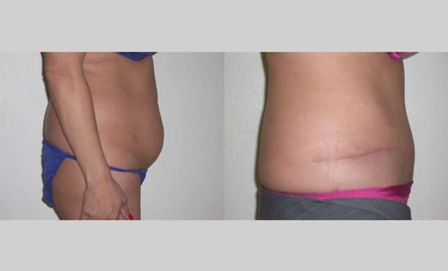 Tummy Tuck: Image #276