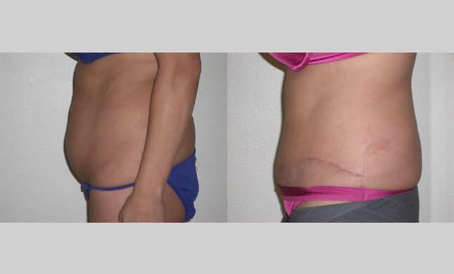 Tummy Tuck: Image #277