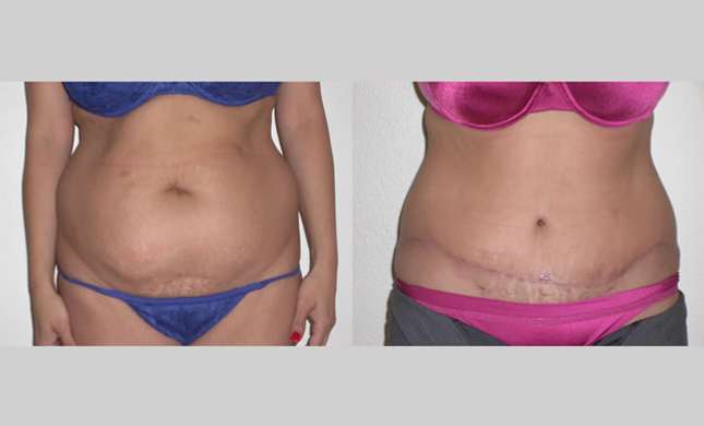 Tummy Tuck: Image #278