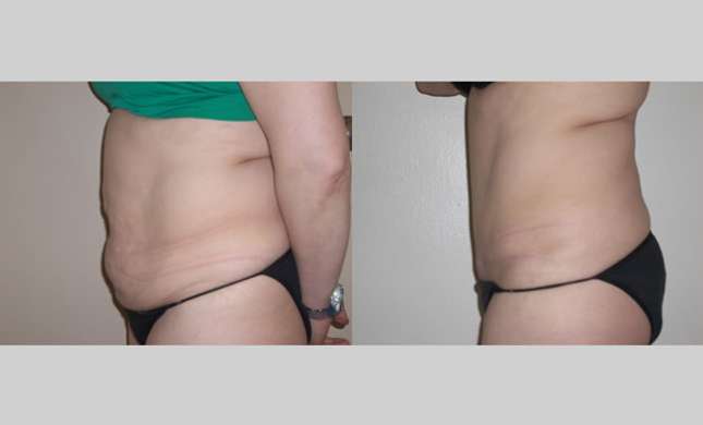 Tummy Tuck: Image #279