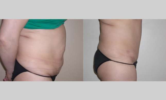 Tummy Tuck: Image #280