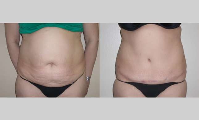 Tummy Tuck: Image #281