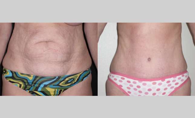 Tummy Tuck: Image #282