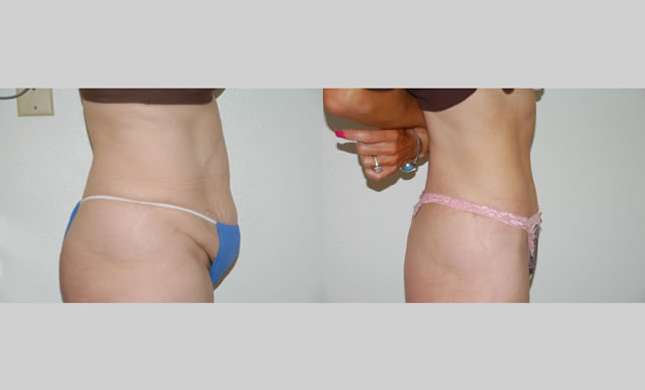 Tummy Tuck: Image #283