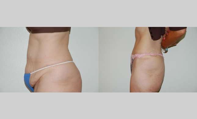 Tummy Tuck: Image #284
