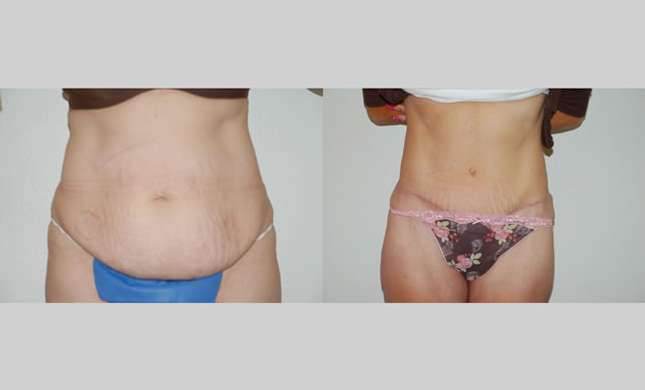 Tummy Tuck: Image #285