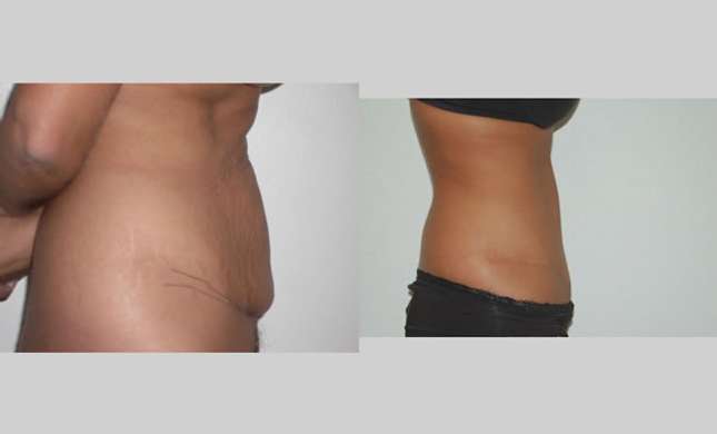 Tummy Tuck: Image #286
