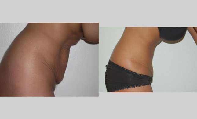 Tummy Tuck: Image #287