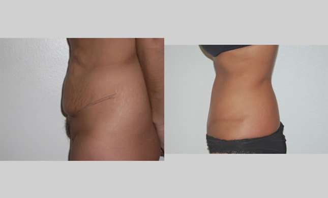 Tummy Tuck: Image #288