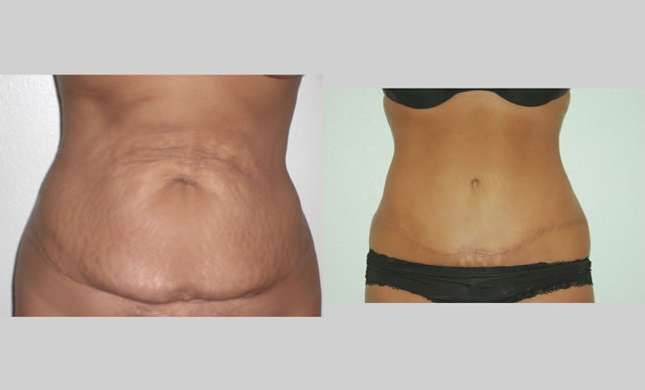 Tummy Tuck: Image #289