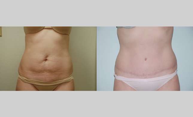Tummy Tuck: Image #290