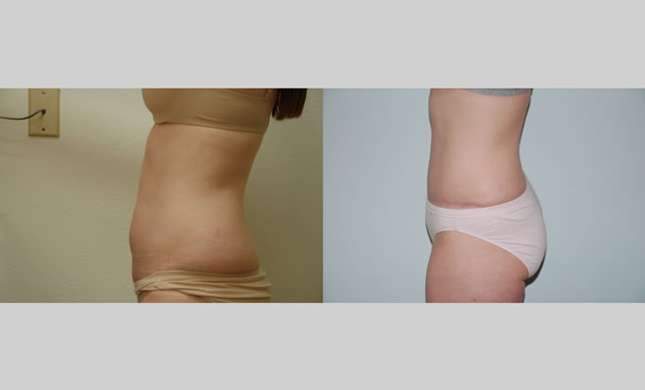 Tummy Tuck: Image #291