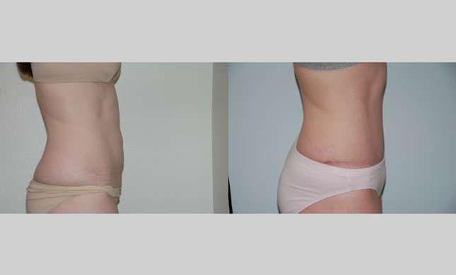 Tummy Tuck: Image #292
