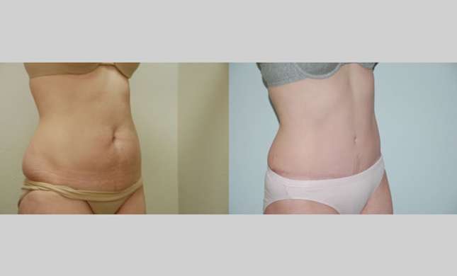 Tummy Tuck: Image #293