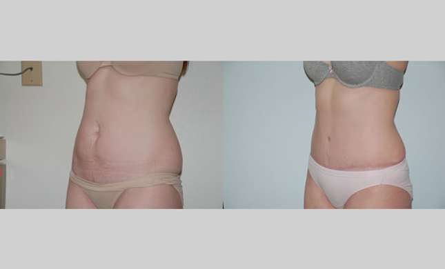 Tummy Tuck: Image #294