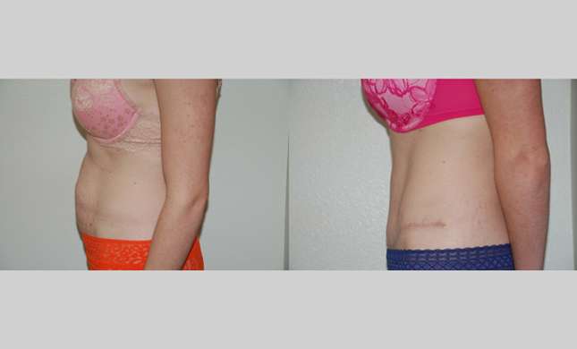 Tummy Tuck: Image #295