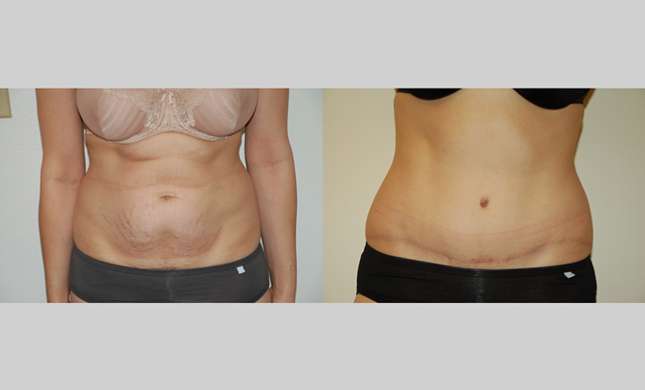Tummy Tuck: Image #296