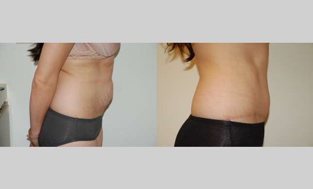 Tummy Tuck: Image #297