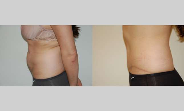 Tummy Tuck: Image #298