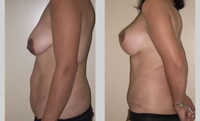 Mommy Makeover: Image #300