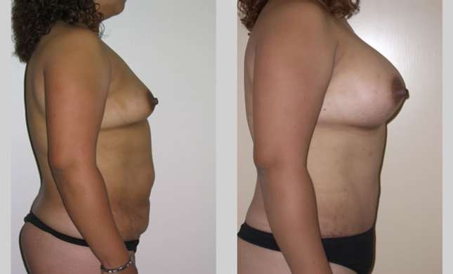 Mommy Makeover: Image #302