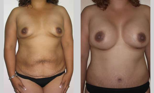 Mommy Makeover: Image #303