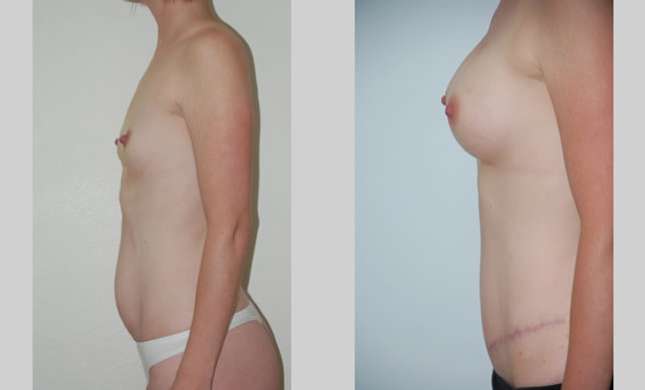 Mommy Makeover: Image #305