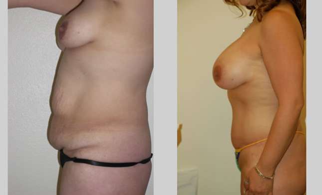 Mommy Makeover: Image #306