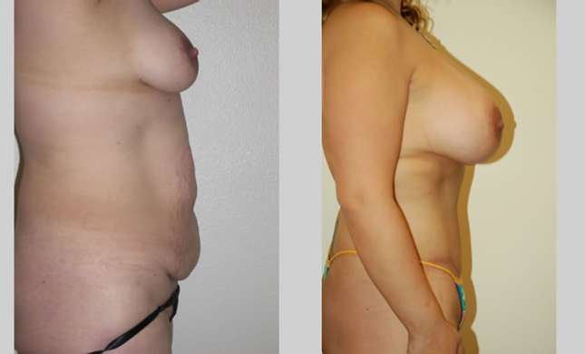 Mommy Makeover: Image #307