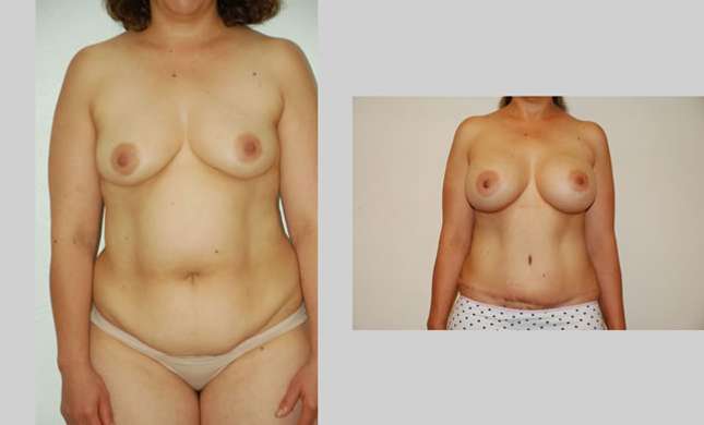 Mommy Makeover: Image #308