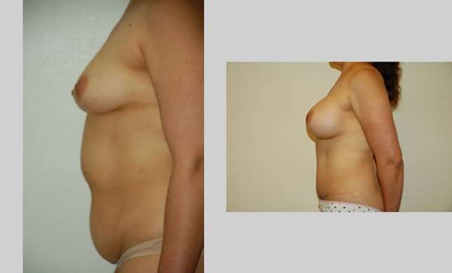 Mommy Makeover: Image #310