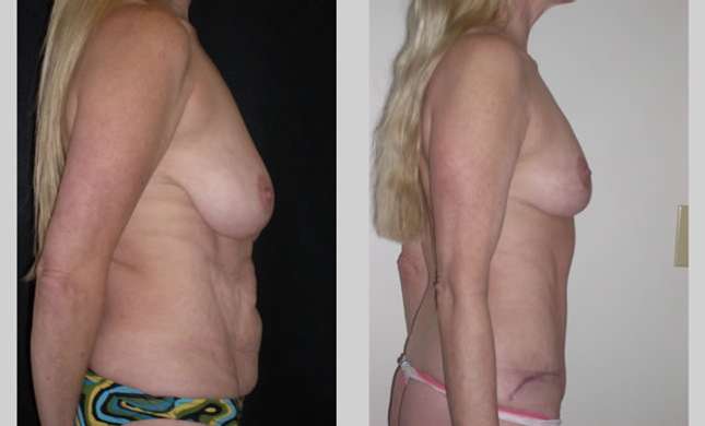 Mommy Makeover: Image #311