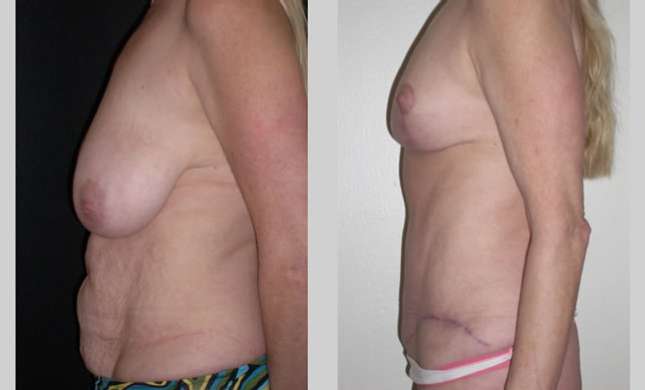 Mommy Makeover: Image #312
