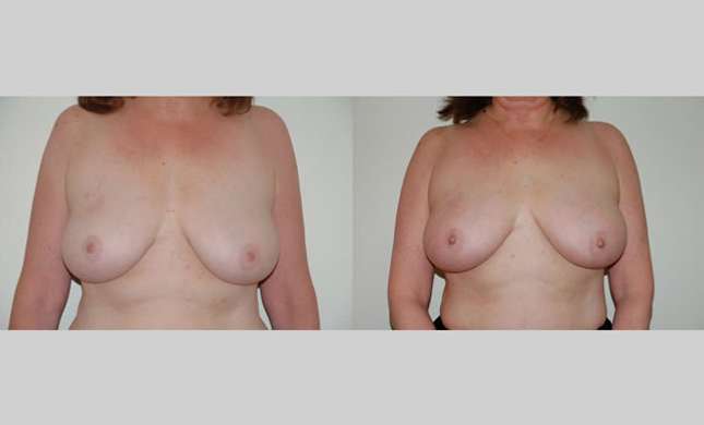 Breast Reconstruction: Image #316