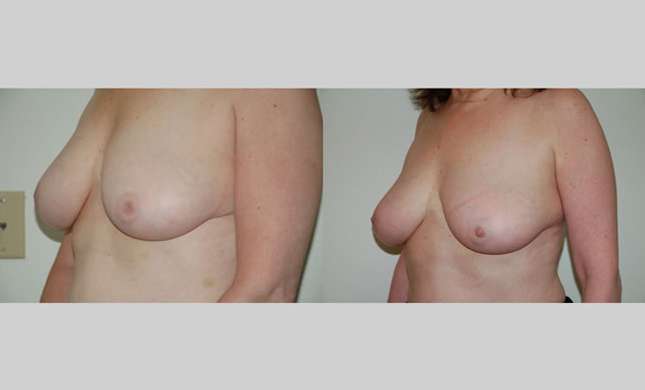 Breast Reconstruction: Image #317