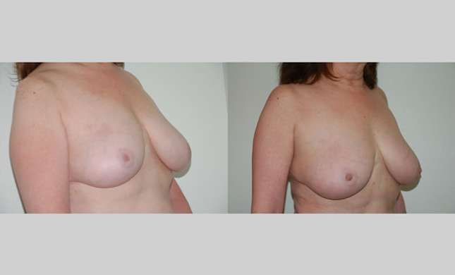 Breast Reconstruction: Image #318